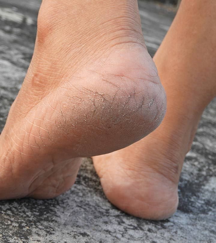 Dry skin and foot care