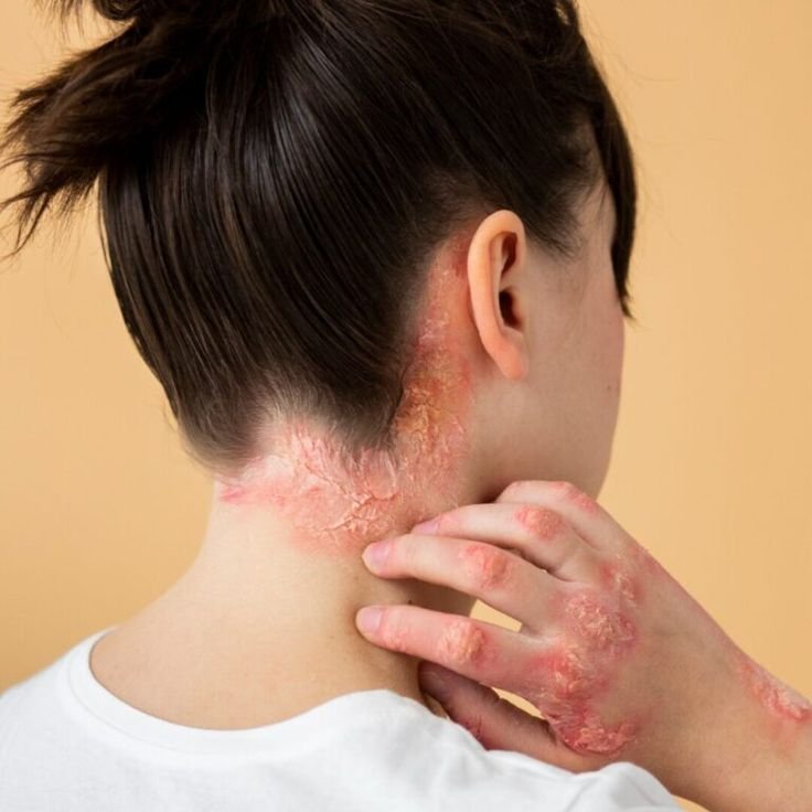 Psoriasis treatment